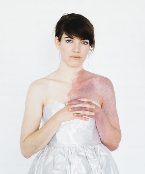 patience hodgson birthmark